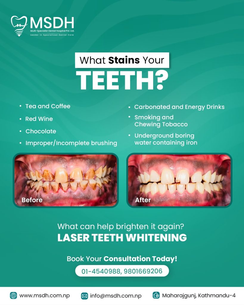 Stains on your teeth?