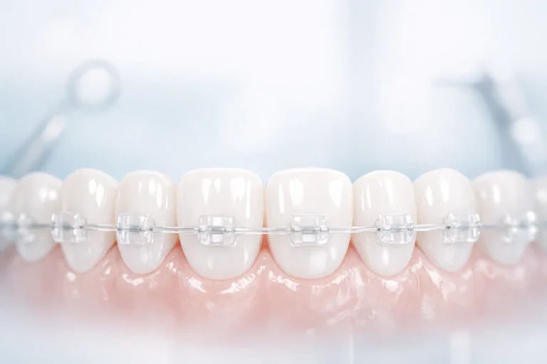 transparent dental braces